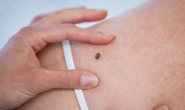 Vacina contra câncer de pele tem resultados positivos e vai entrar em fase final de estudo