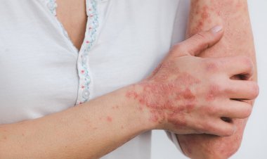 Psoríase: conheça os sinais para procurar um médico e quais fatores podem ser gatilhos para a doença autoimune