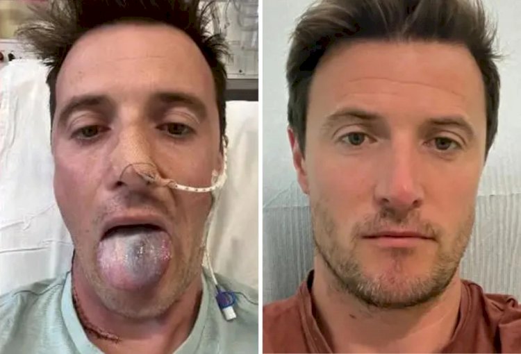 Homem quase perde a língua por causa do HPV: 'Não sabia que poderia causar câncer em homens'